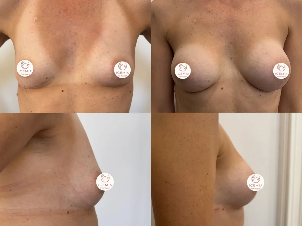 Procédure Preservé pour regalber les seins à Béziers