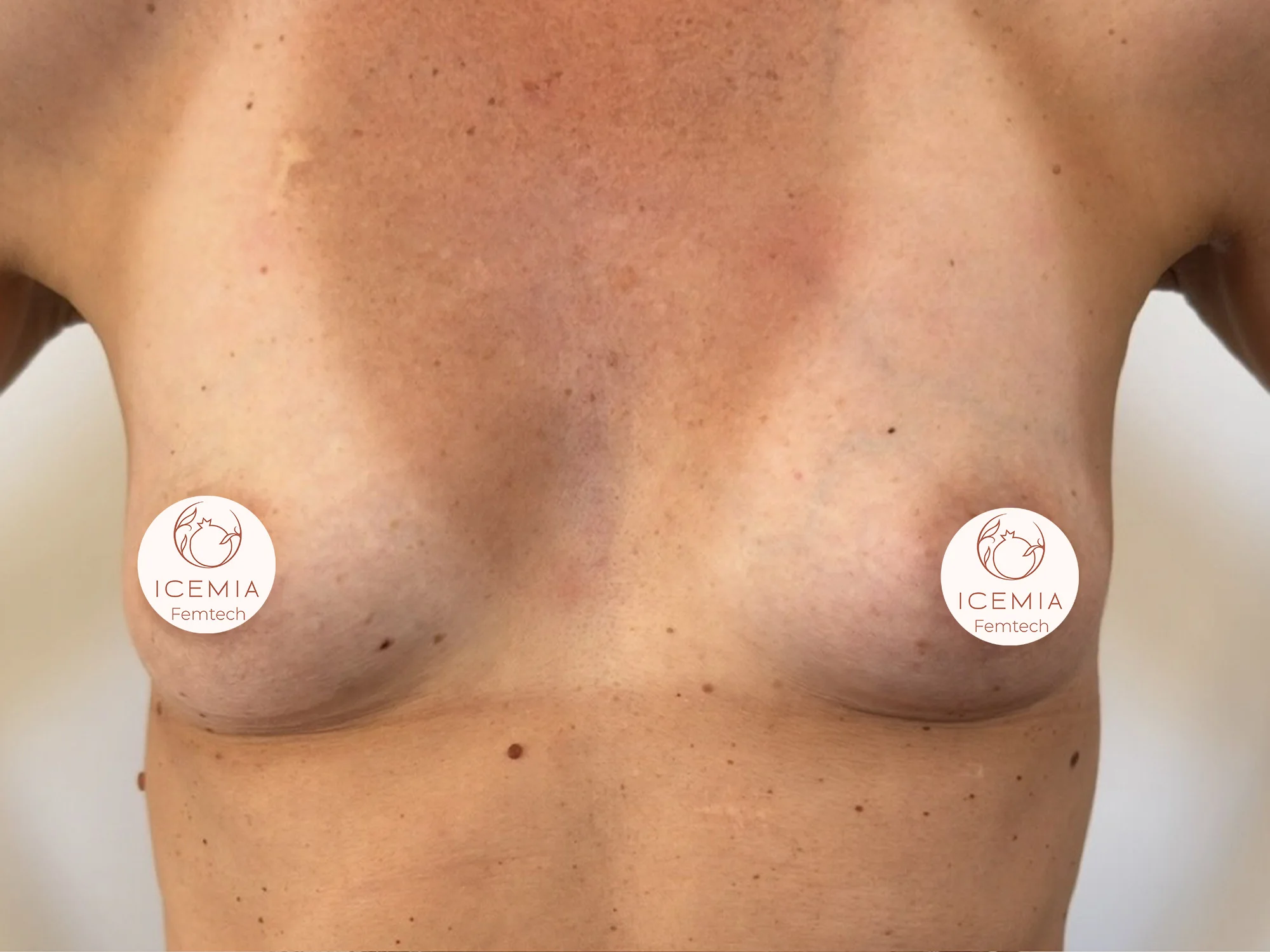 Photo regalber les seins avant procédure Preservé Icemia à Béziers vue de face