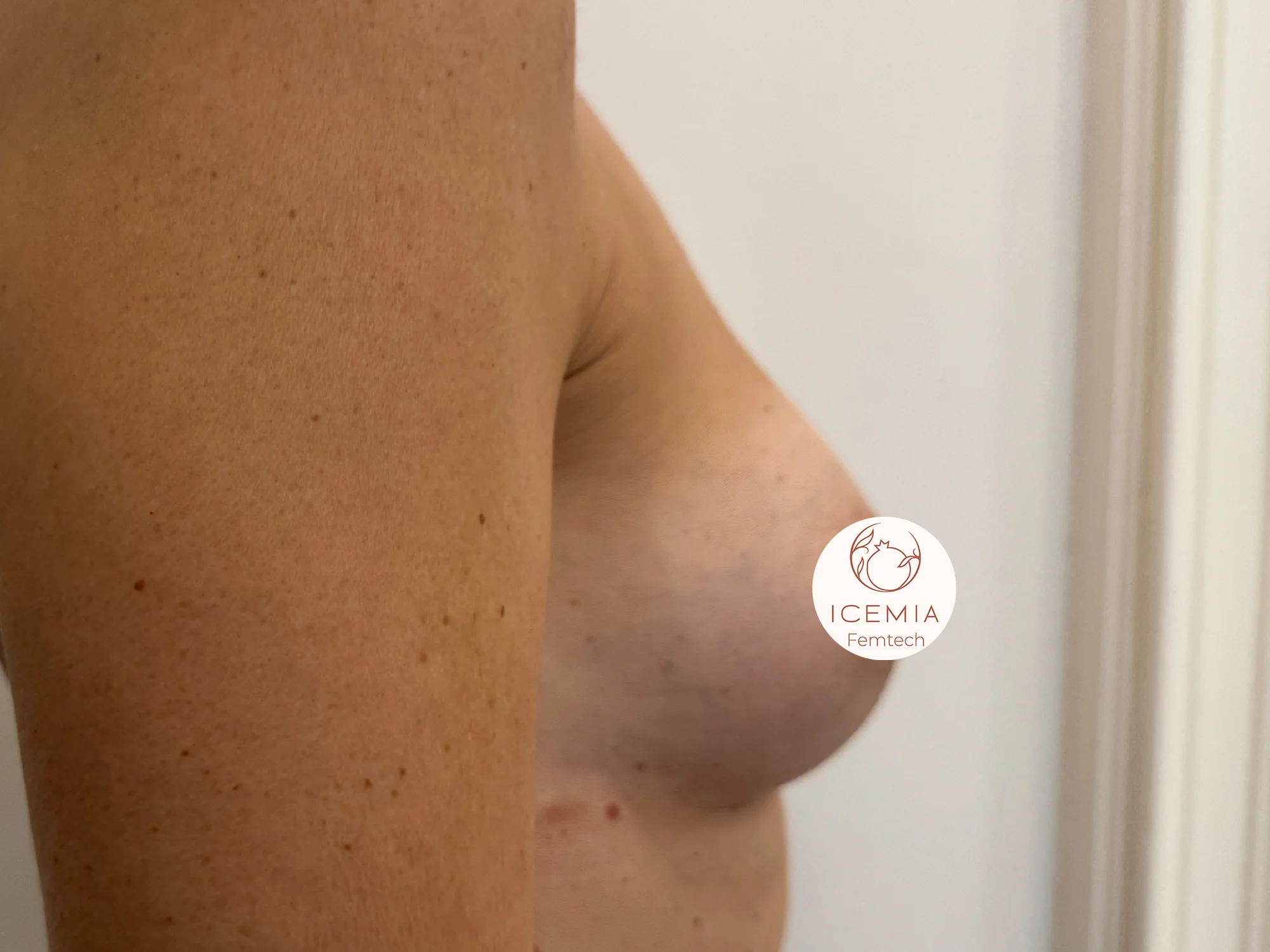 Photo regalber les seins après procédure Preservé Icemia à Béziers vue de profil