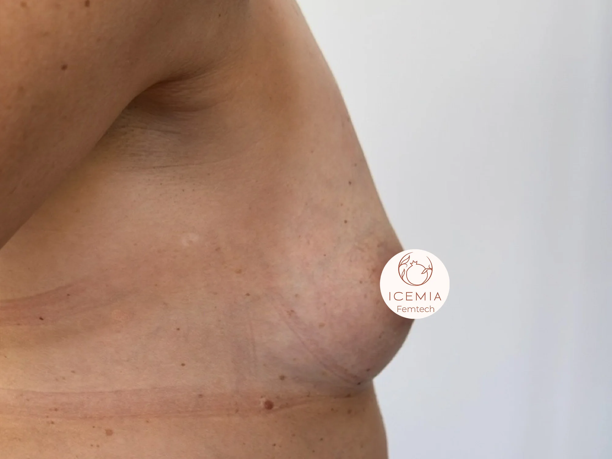 Photo regalber les seins avant procédure Preservé Icemia à Béziers vue de profil